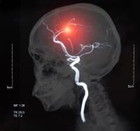 Portable MRI shows promise for stroke detection in ED: ©Utah51 - stock.adobe.com