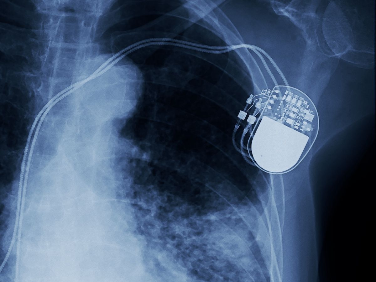 X-ray image of a pacemaker implant © Choo - stock.adobe.com