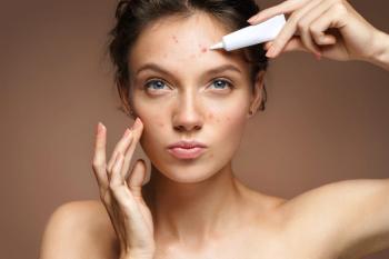 teen girl acne cream skincare concept: © Romario Ien - stock.adobe.com