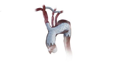 FDA approves Endospan’s stent graft for aortic arch disease: ©Endospan