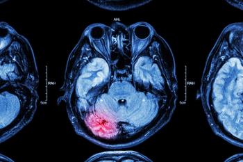 Brain swelling management device receives FDA designation: ©Stockdevil - stock.adobe.com