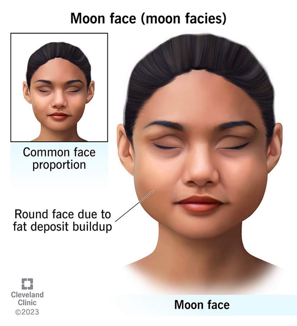 The Truth About moon Face Understanding The Real Medical Condition the-truth-about-moon-face-understanding-the-real-medical-condition