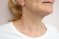 FDA approves Skinvive to address horizontal neck wrinkles, “tech neck”