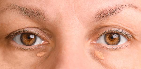 Xanthelasma tied to a higher risk of heart attack and stroke