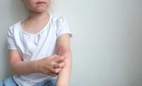 girl scratching rash on her arm | ©marishkaTR stock.adobe.com