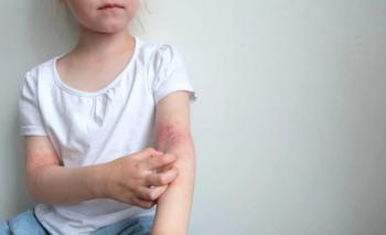 girl scratching rash on her arm | ©marishkaTR stock.adobe.com