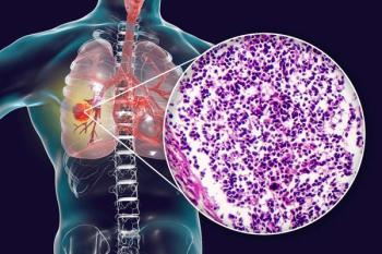 medical illustration of lungs with histology of small cell lung cancer pulled out | ©dr_microbe stock.adobe.com