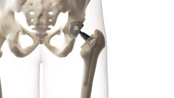 hip replacement skeleton | Image credit sciepro stock.adobe.com