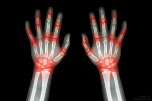 Joint pain on xray