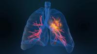 Amivantamab, chemo combo shows nearly 3-year survival in EGFR exon 20 lung cancer