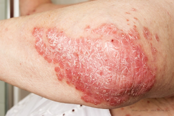 Psoriasis
