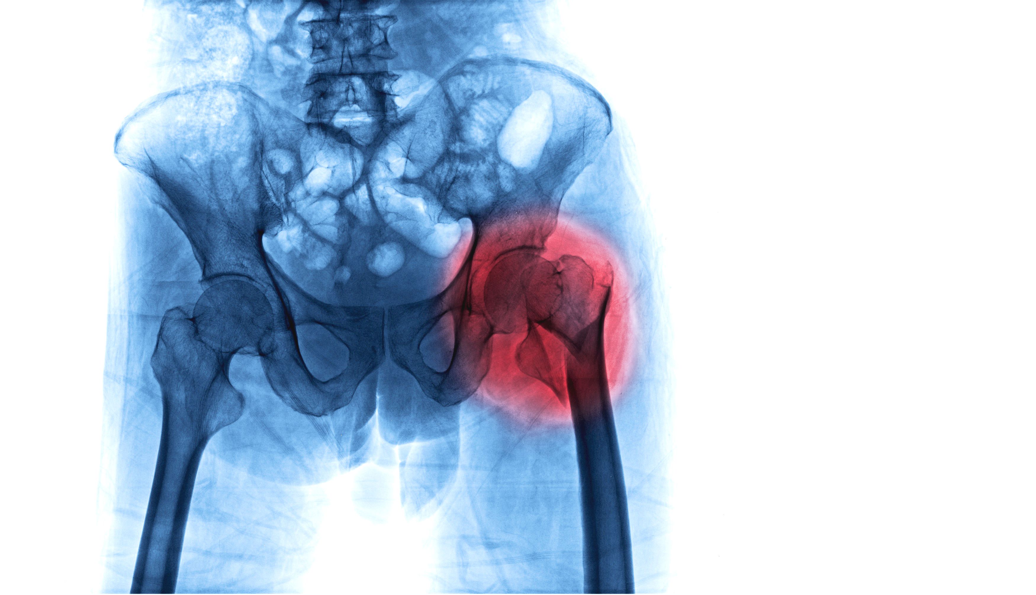 Lower education tied to higher death risk after hip fracture surgery, study finds