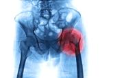 Lower education tied to higher death risk after hip fracture surgery, study finds