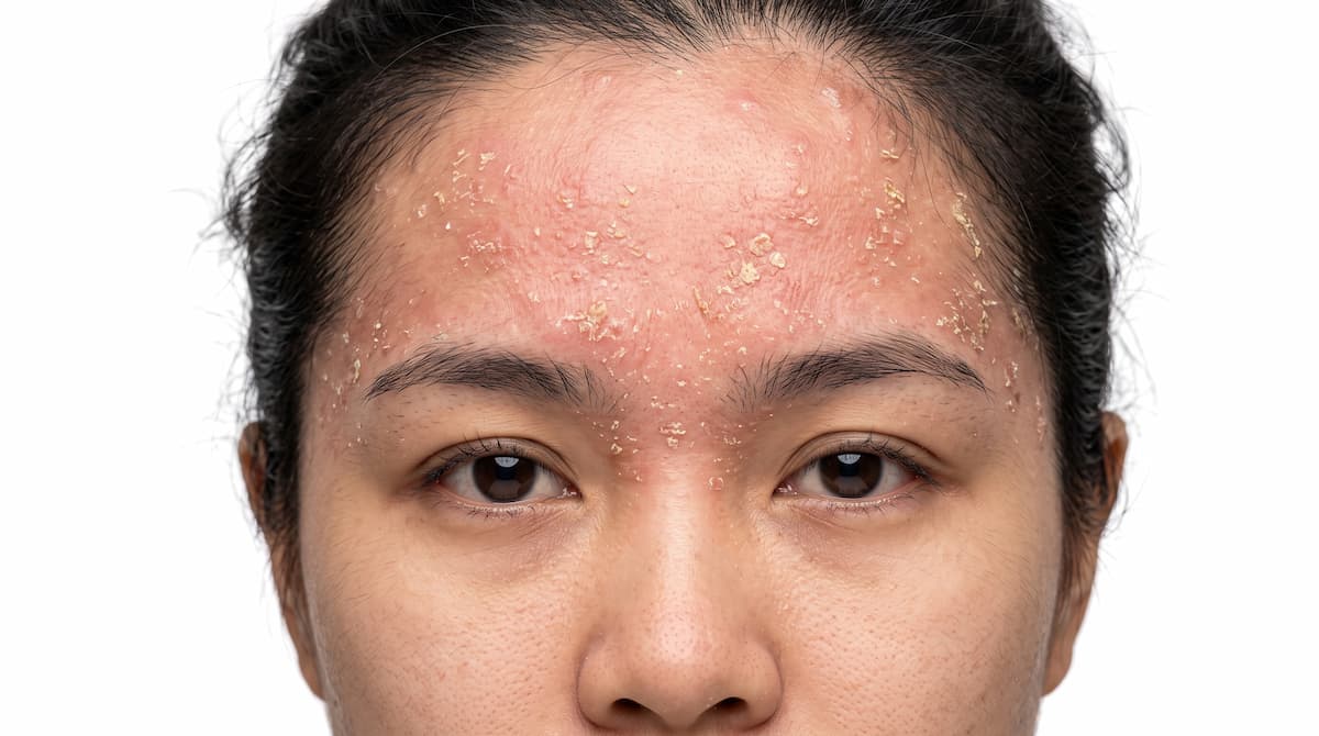 Anti-inflammatories instead of antifungals for seborrheic dermatitis
