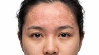Anti-inflammatories instead of antifungals for seborrheic dermatitis 