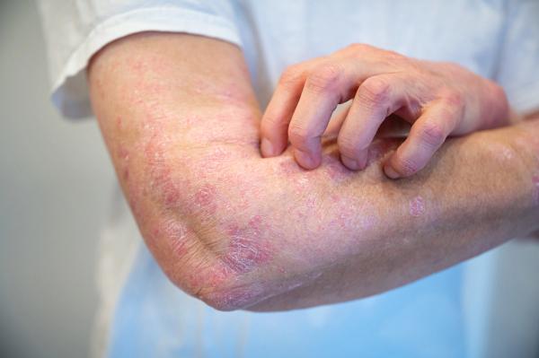 Newer biologics show strong drug survival for psoriasis patients