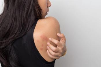 woman in black top with urticaria on back of her shoulder | image credit: ©suriya stock.adobe.com