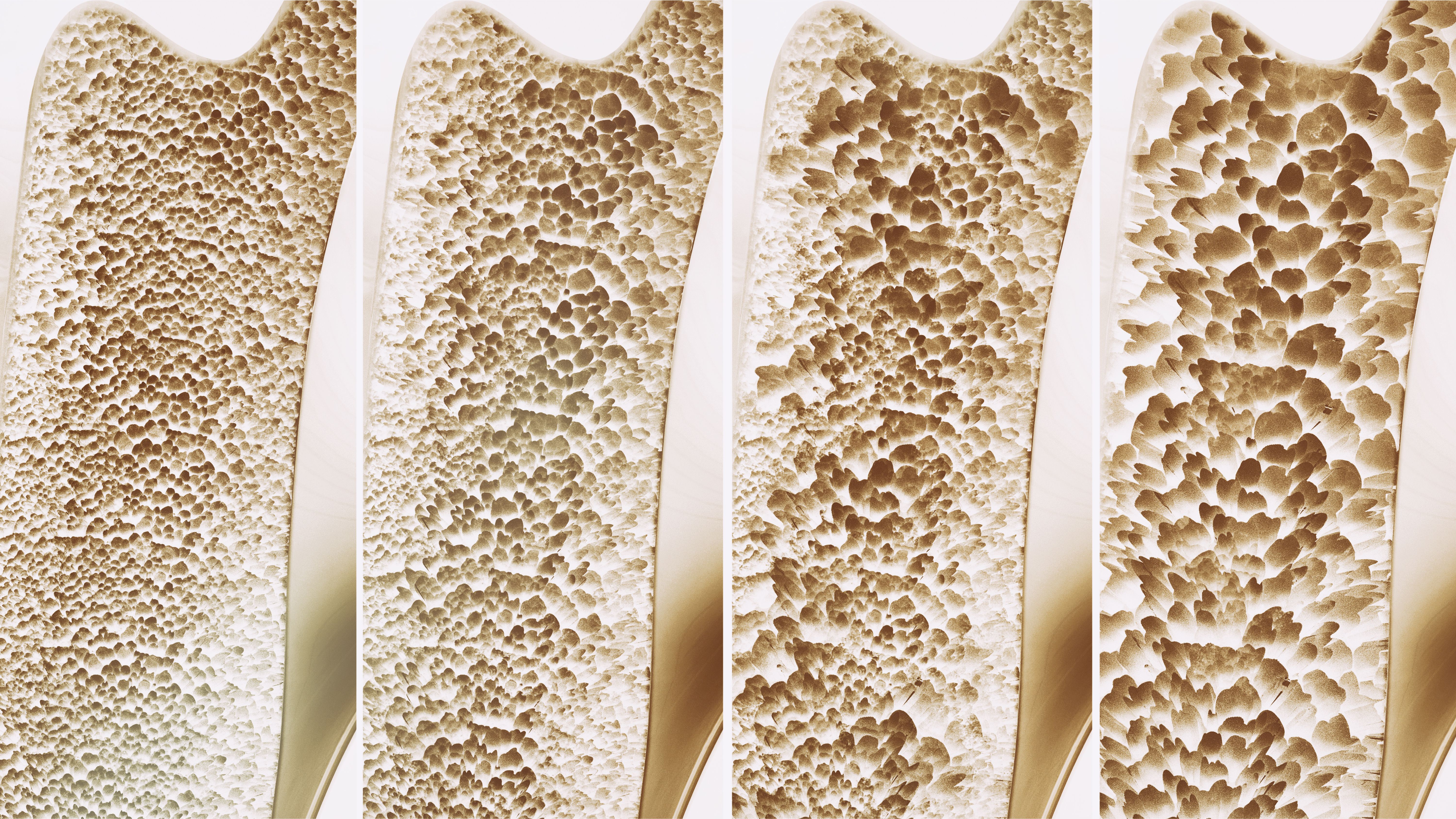 Stoboclo Instructions.pdf FDA Approves Prolia and Xgeva Biosimilars, Stoboclo and Osenvelt