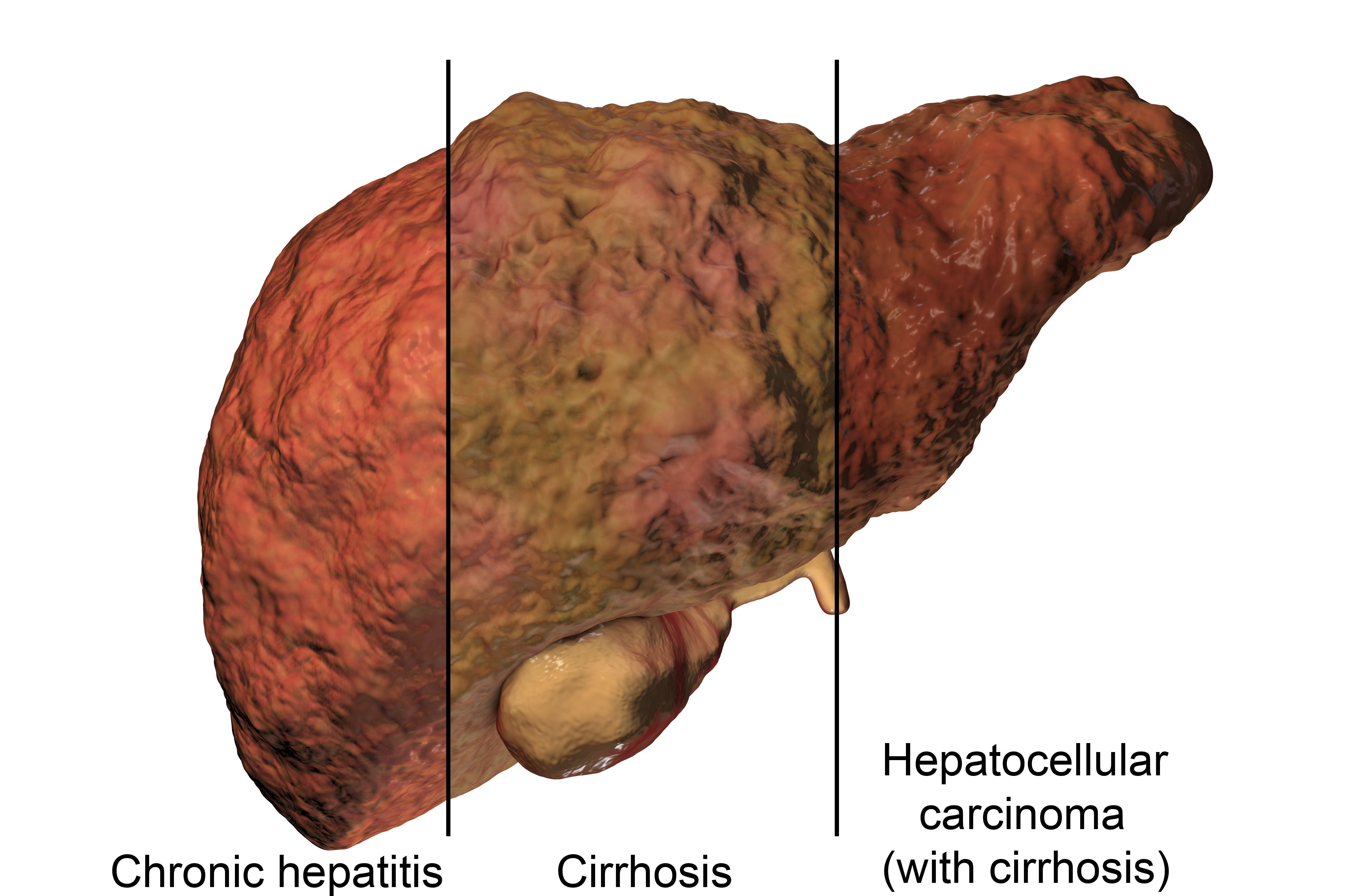 Hepatocellular Carcinoma Patient