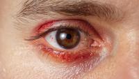 Could uveitis in patients with melanoma being treated with immune checkpoint inhibitors be a good thing?