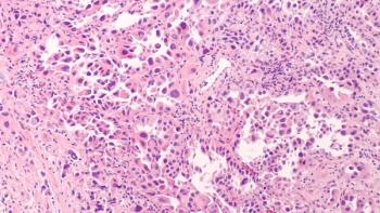 pinkish issue of lung ca adenocarcinoma | ©David A. Litman stock.adobe.com