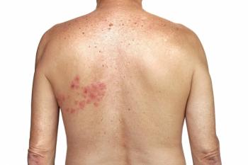 white male back with rash caused by shingles on the right side