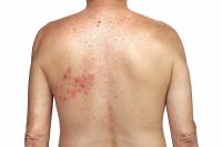 white male back with rash caused by shingles on the right side