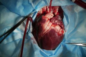 Research Shows That Epicardial Fat Tissue Volume May Have Predictive Value For Atrial Fibrillation 
