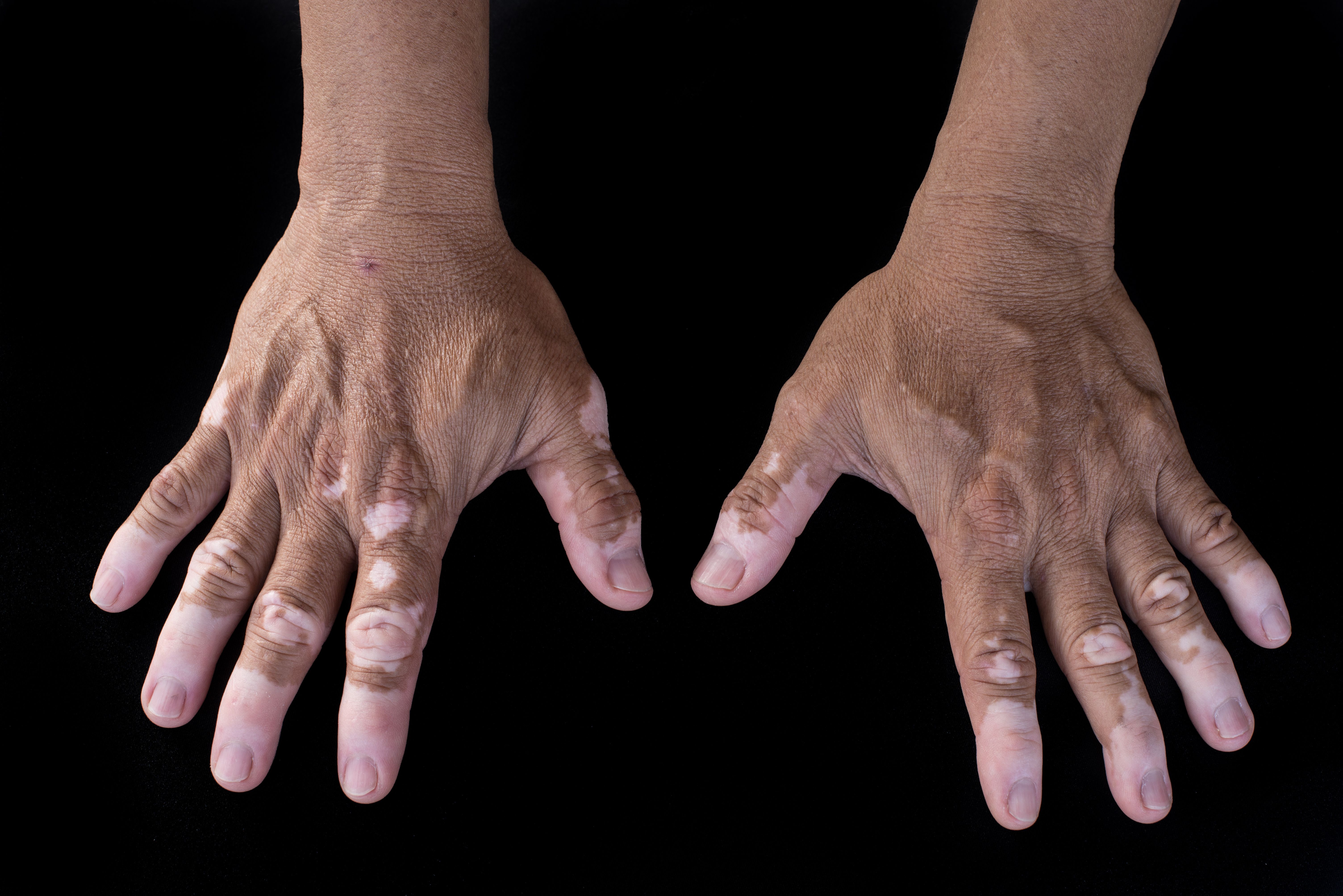 <![CDATA[Japanese study finds vitiligo has a strong impact on daily life and mental health]]>