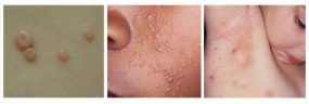Ycanth Rash FDA Approves Ycanth to Treat Molluscum Contagiosum
