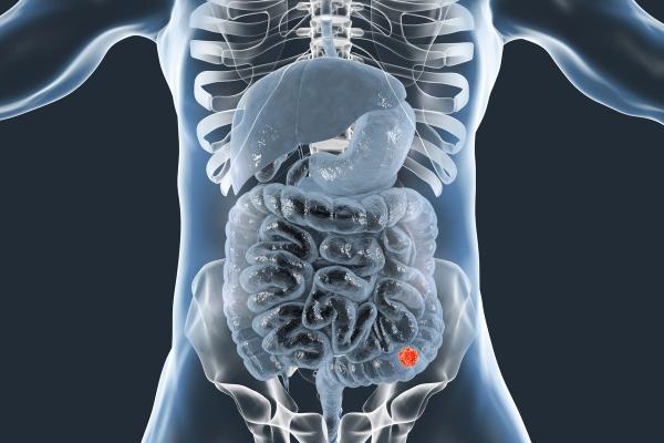 Cogent Biosciences’ phase 3 PEAK trial marks an advance in the treatment of gastrointestinal stromal tumors.