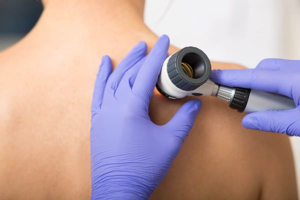 someone wearing blue gloves using a dermatoscope on white person's shoulder  image credit: @peakstock stock.adobe.com