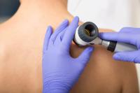 someone wearing blue gloves using a dermatoscope on white person's shoulder image credit: @peakstock stock.adobe.com