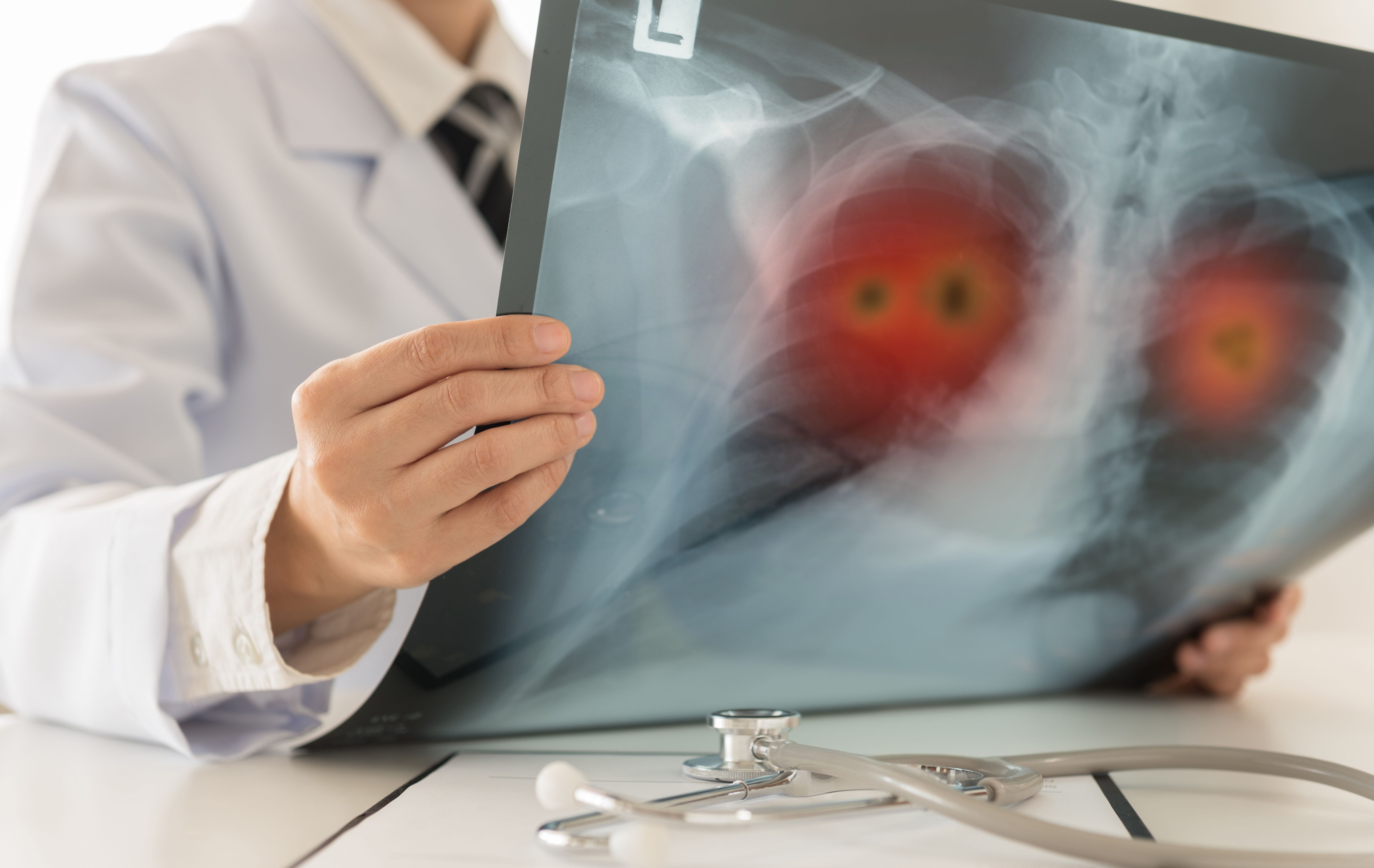 FDA Approves Ibtrozi For Adults With ROS1+ NSCLC