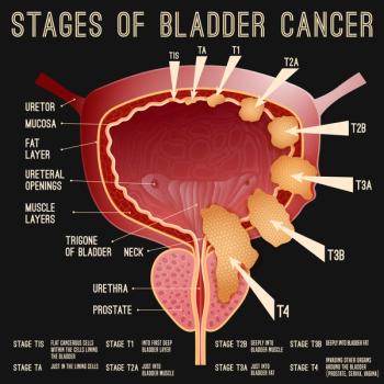 illustration of the stages of bladder cancer | ©double brain stock.adobe.com