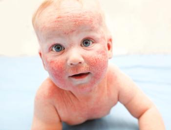 baby with atopic dermatitis © SkyLine - stock.adobe.com