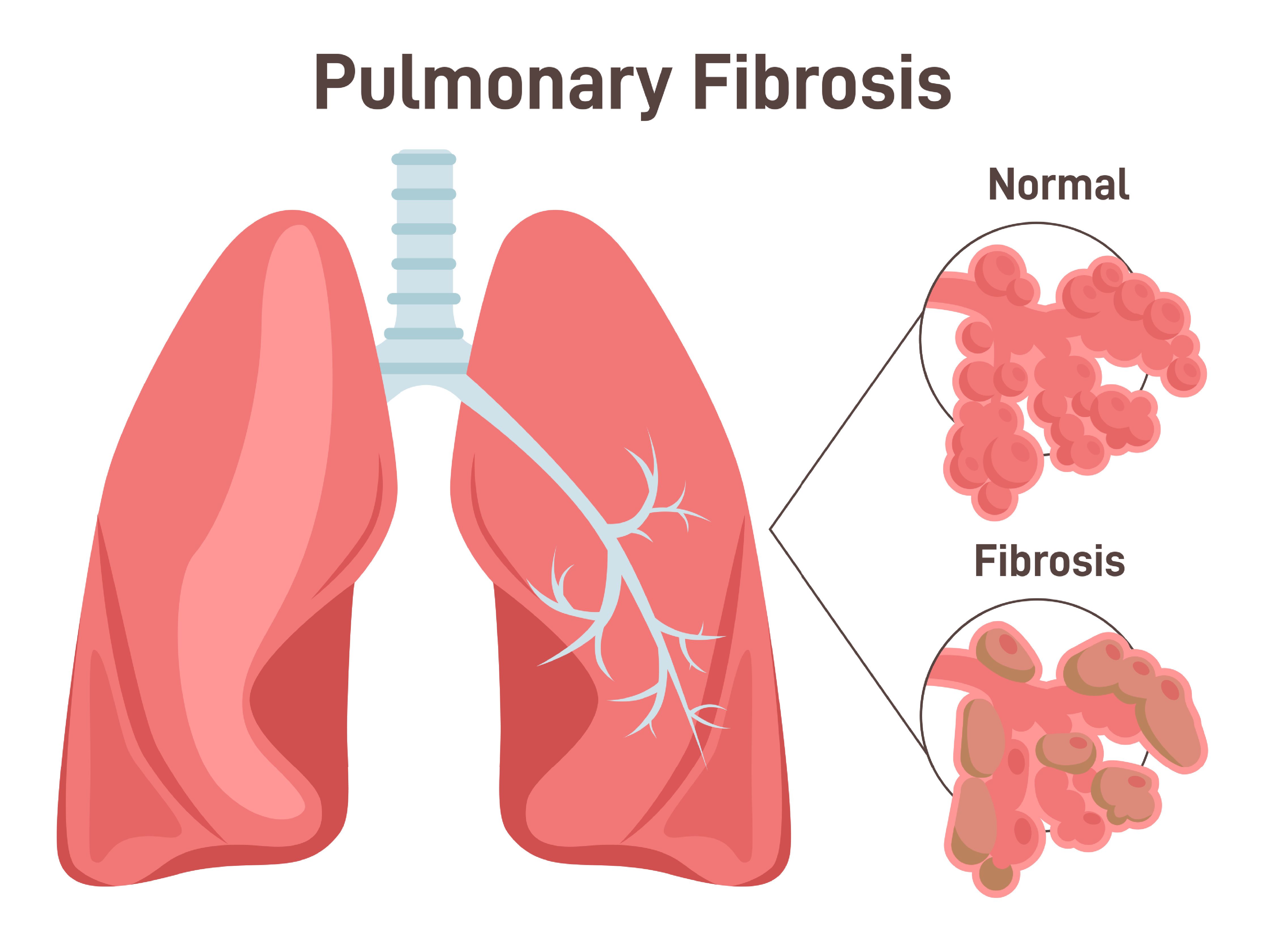 drawing of pulmonary fibrosis | image credit: ©inspiring.team stock.adobe.com