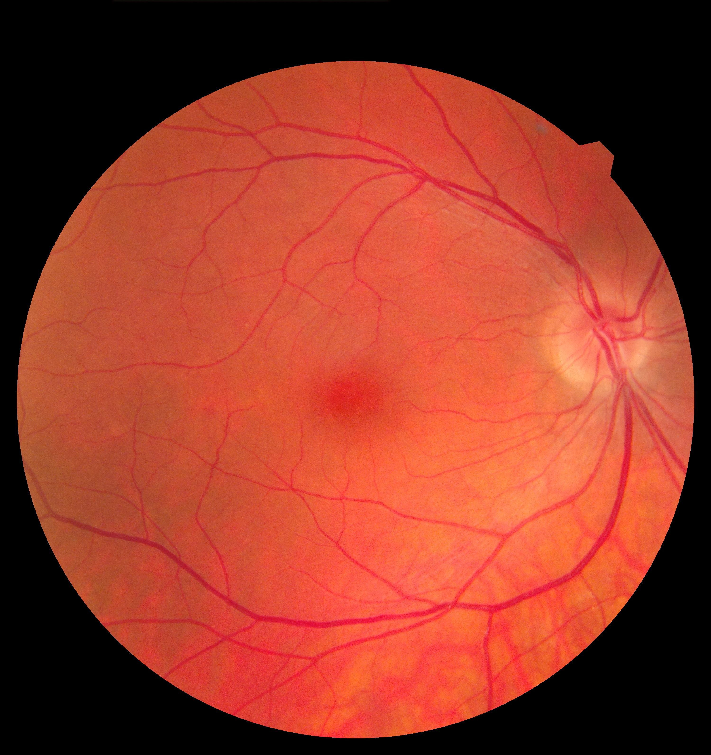 What Is The Difference Between Eylea And Eylea Hd New Study Shows Extended-Dose EYLEA HD is Effective for wAMD and DME