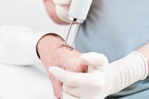 SkinCure Oncology Secures Patent for Innovative Image-Guided Technology in Nonmelanoma Skin Cancer Treatment