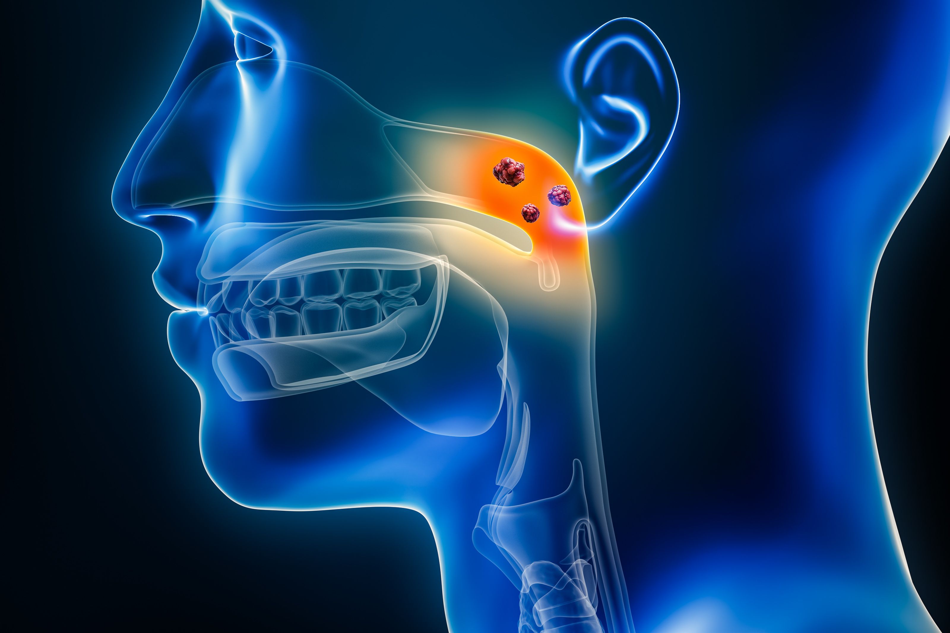 FDA Approves First Treatment for Nasopharyngeal Carcinoma