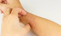 FAQ: A message to health systems and payers: chronic itch is more than a skin problem
