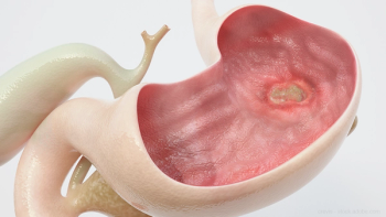 Stomach ulcer