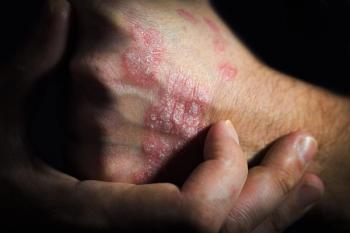 Psoriasis on hand | Image credit:  SergeVo stock.adobe.com