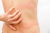 Cholinergic urticaria: Hives caused by heat and what can be done about it