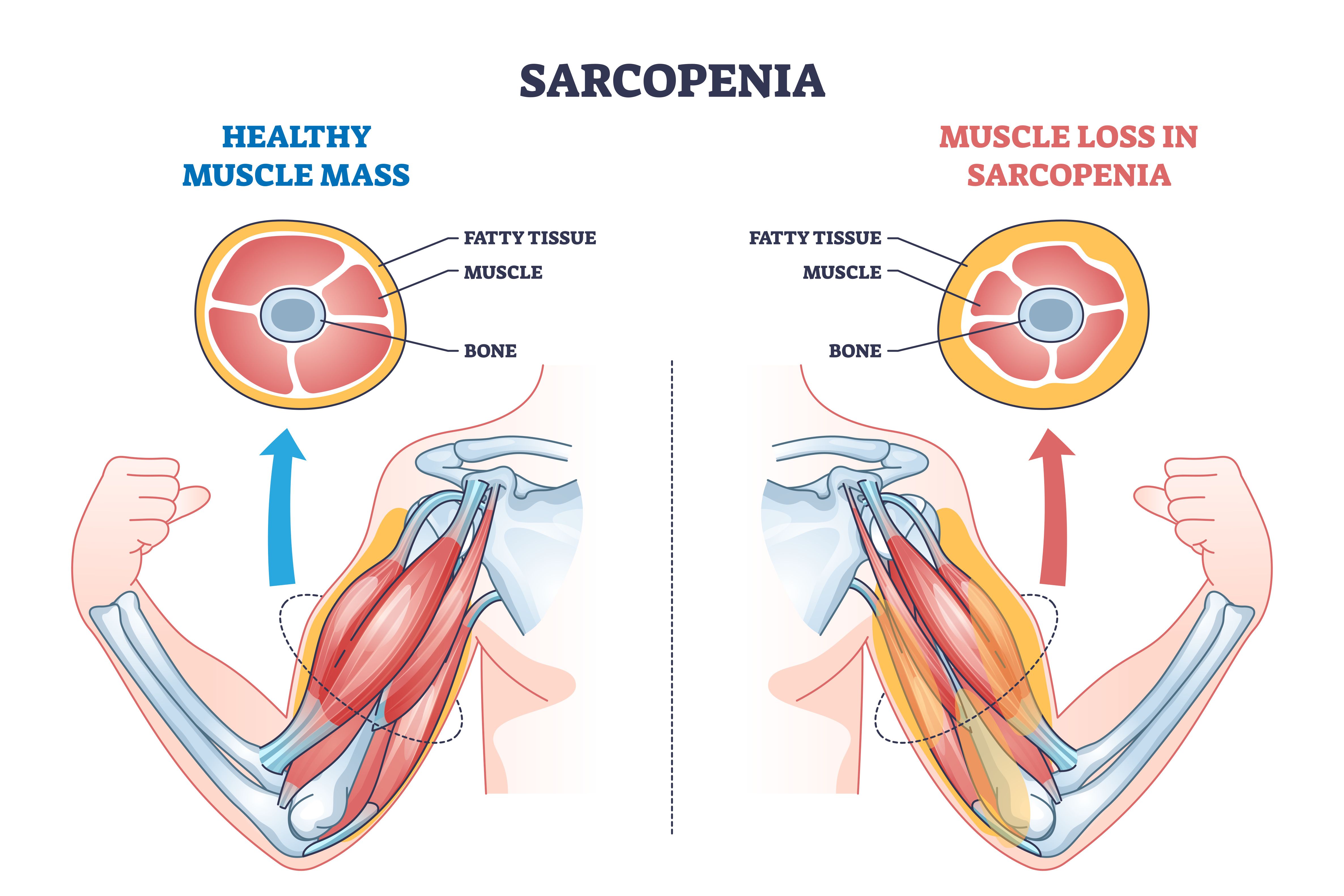 <![CDATA[Sarcopenia affects patients with ELD, ILD and pulmonary hypertension, new study shows]]>