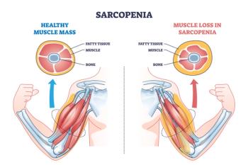 Illustration comparing healthy muscle to sarcopenia | ©VectorMine stock.adobe.com