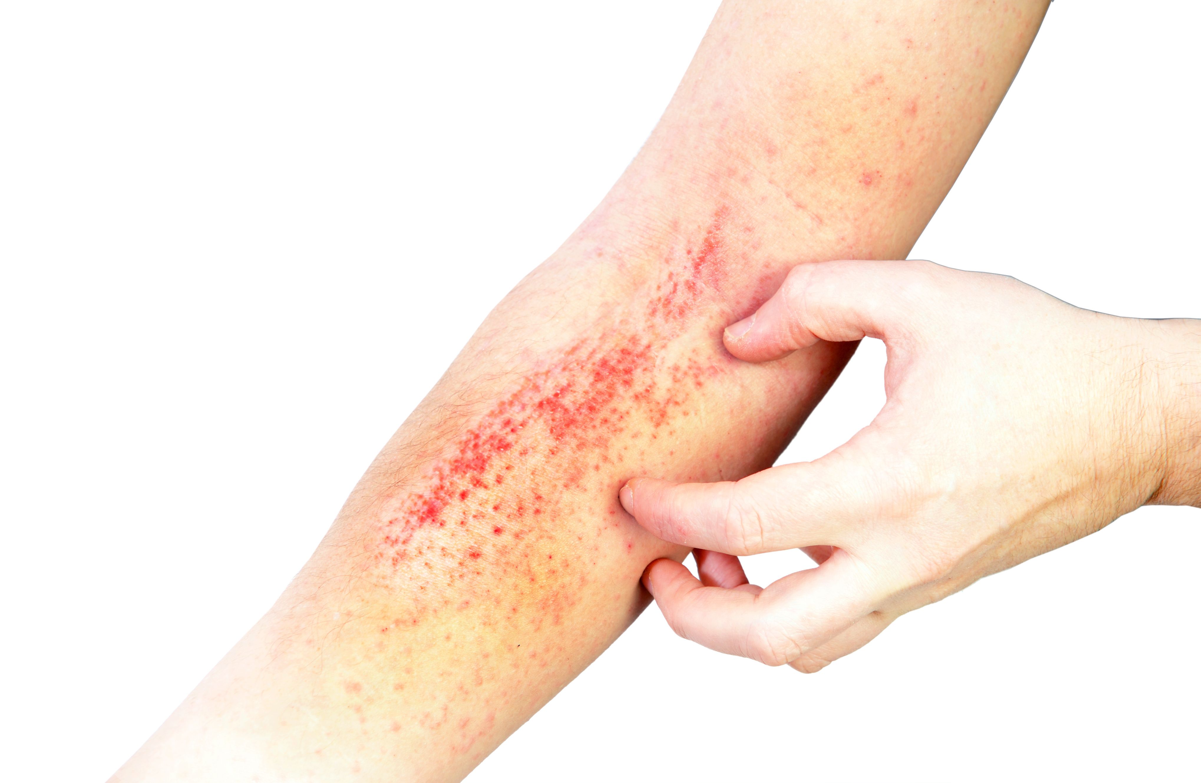 Lebrikizumab Maintains Skin Clearance For Two Years In Atopic Dermatitis