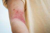 FDA approves new Ebglyss maintenance dose for moderate to severe atopic dermatitis patients  