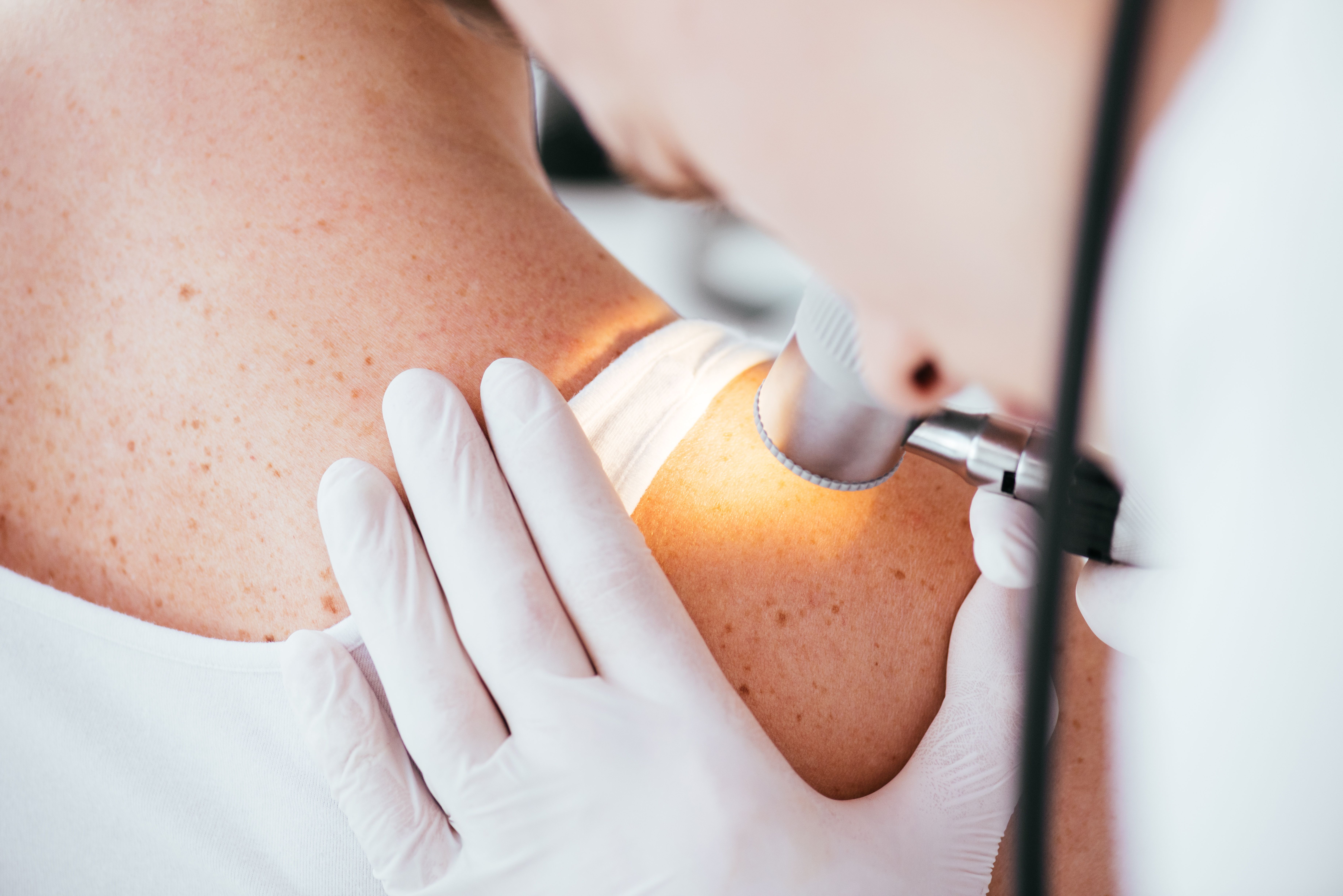 FDA Accepts BLA for Lifileucel for Difficult-to-Treat Melanoma