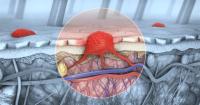 Five years later, personalized mRNA vaccine cuts melanoma recurrence risk by half